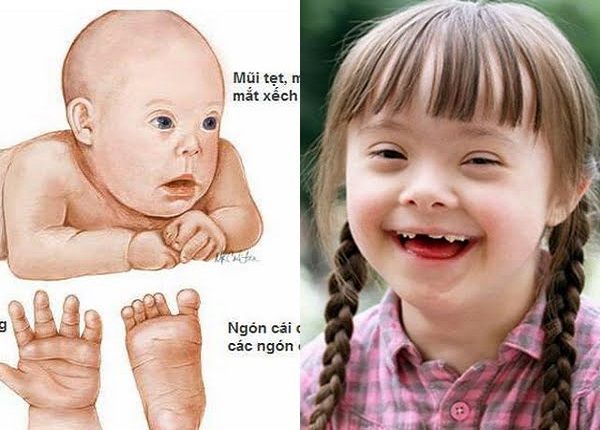 đột biến số lượng nhiễm sắc thể và hình ảnh minh họa