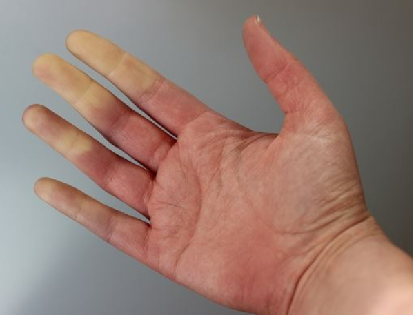 tìm hiểu hội chứng raynaud là gì