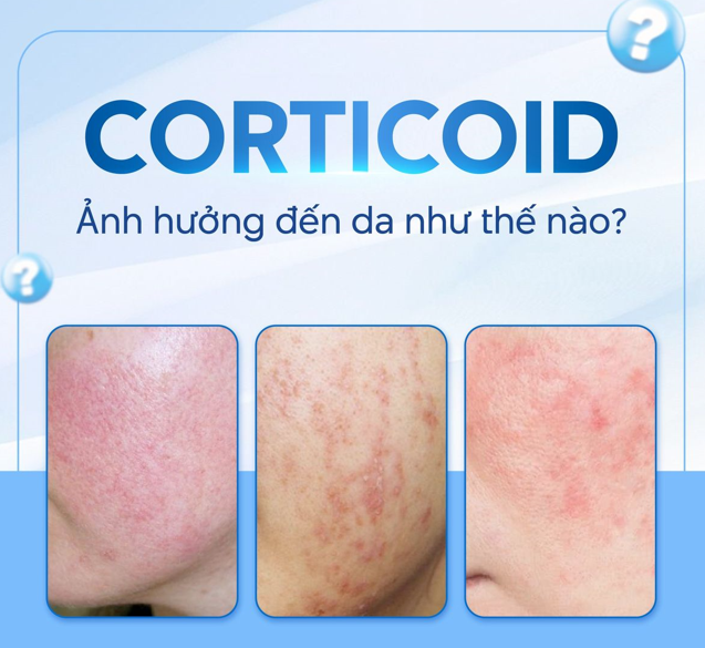 tìm hiểu về corticoid là gì