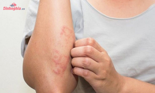 Bệnh zona thần kinh là gì? Nguyên nhân, Triệu chứng và Cách điều trị