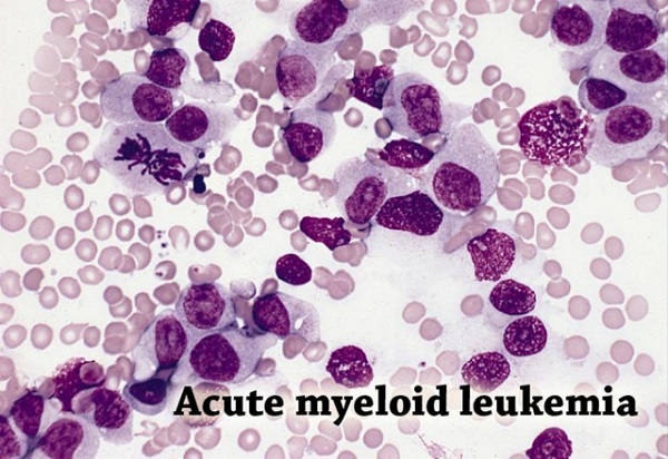 bạch cầu cấp dòng lympho l1 và sự nguy hiểm của căn bệnh này
