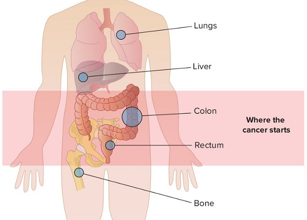 ung thư di căn sống được bao lâu và khái niệm ung thư di căn