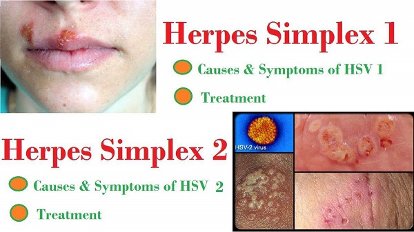 tìm hiểu khái niệm herpes là bệnh gì
